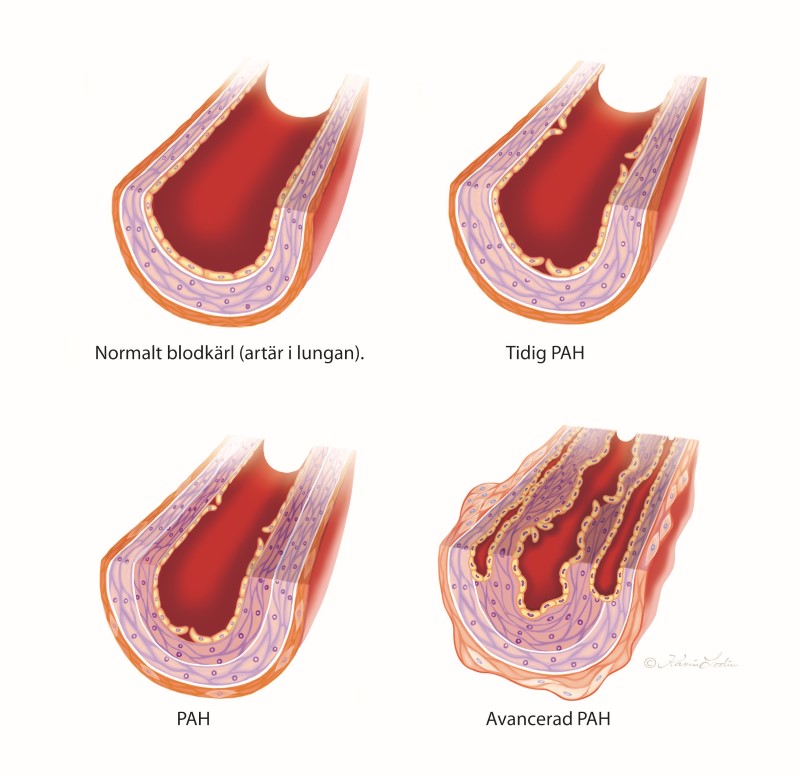 PAH - pulmonell arteriell hypertension.