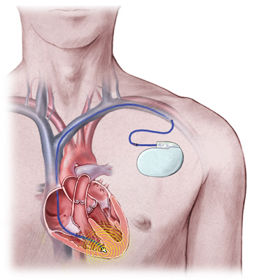 Behandling med implanterbar defibrillator, ICD